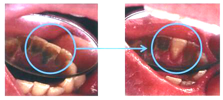 歯石除去前、歯石除去後
