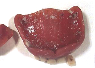 歯垢(しこう)が付着した入れ歯